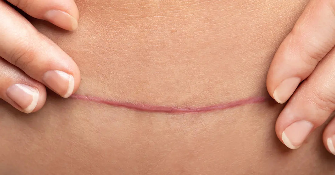 Post-C-Section Recovery: Restoring Your Abdomen and Minimizing Scars