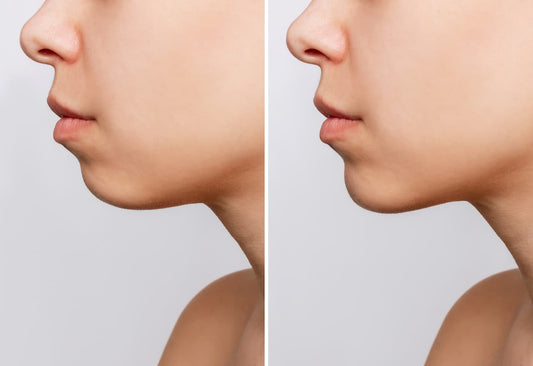 Jowls Be Gone: Smooth Your Jawline Without Surgery