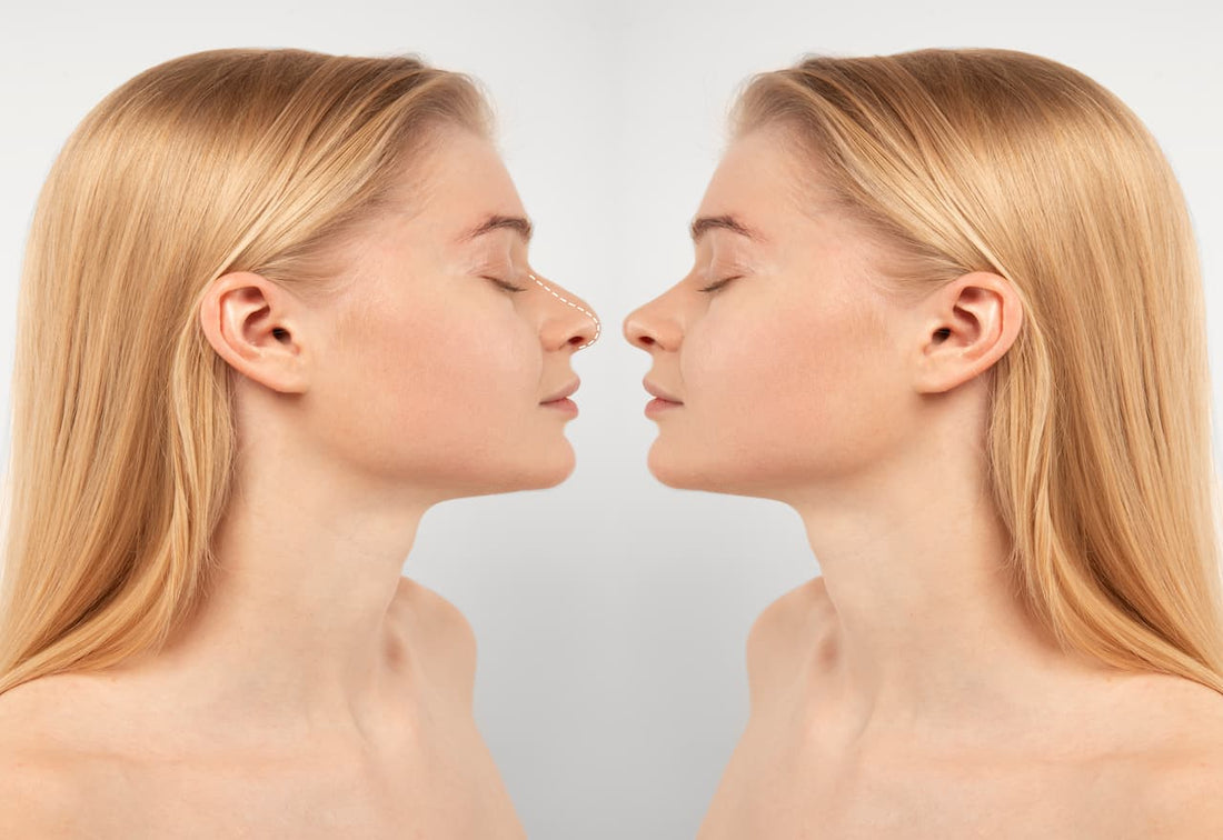 Rhinoplasty or Nose Fillers? Let’s Break It Down