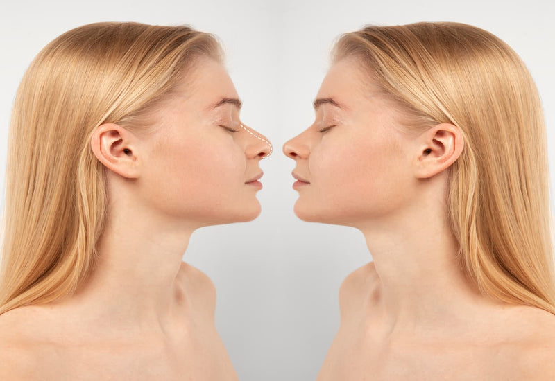 Rhinoplasty or Nose Fillers? Let’s Break It Down