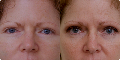 Before and after close-up of a woman's eyes and forehead, showing results of an eye lift procedure.