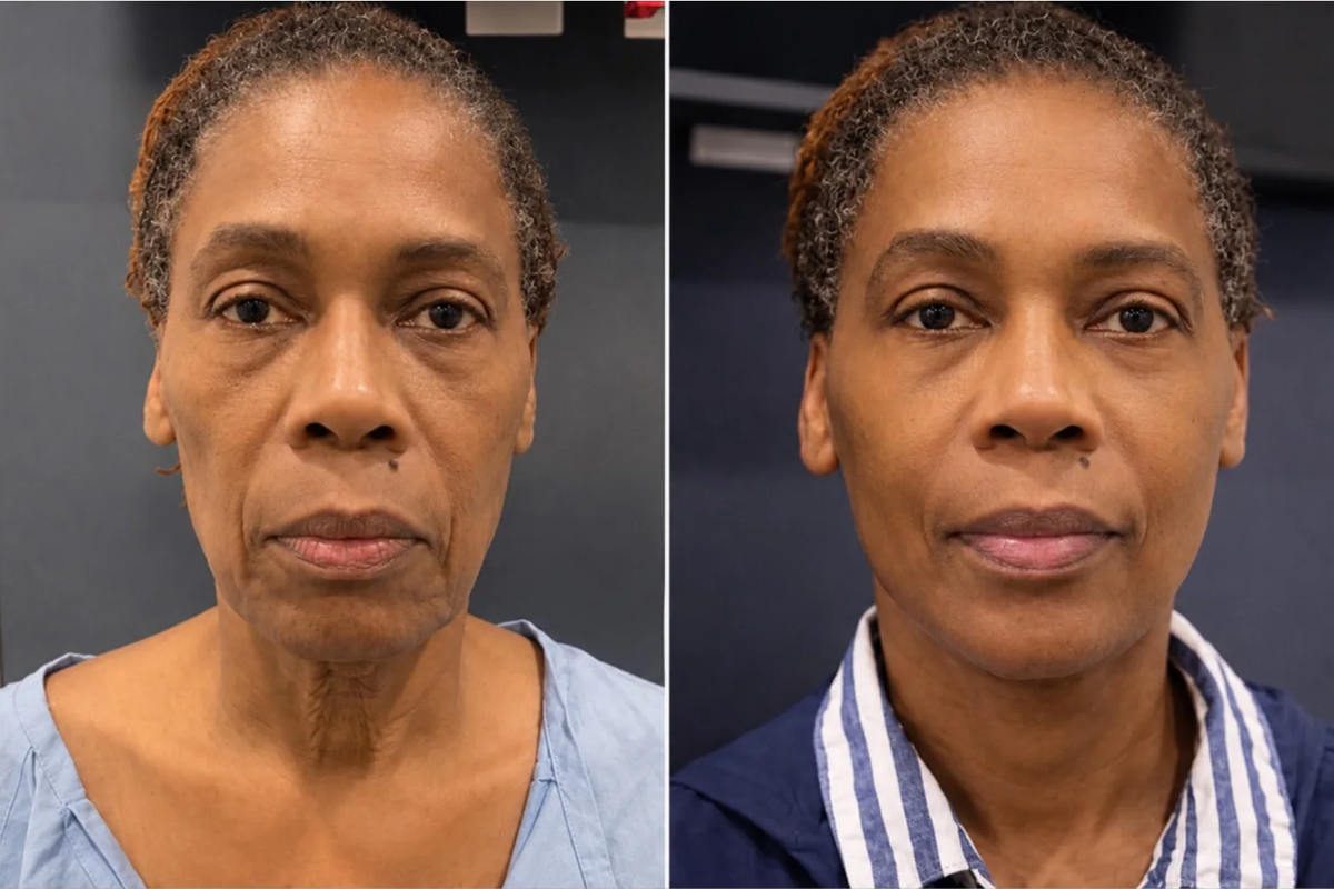 Before and after facelift and neck lift, front view. Patient who wanted to restore facial definition.