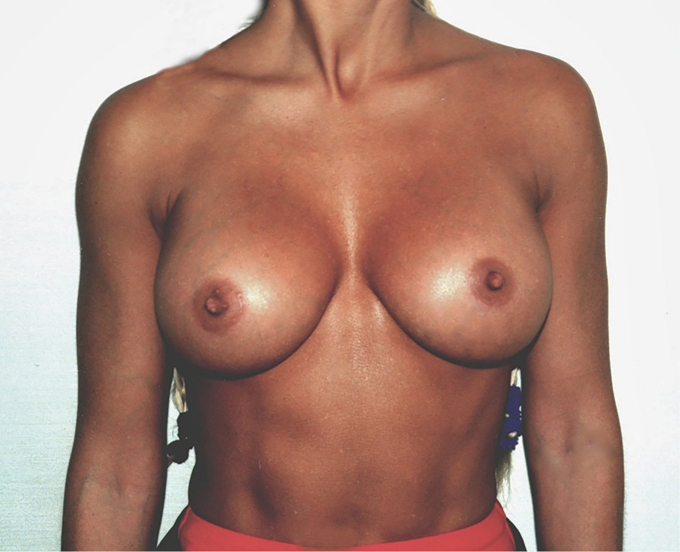 After – Case 10 · Age 30 · Silicone implants · Submuscular placement · High profile
