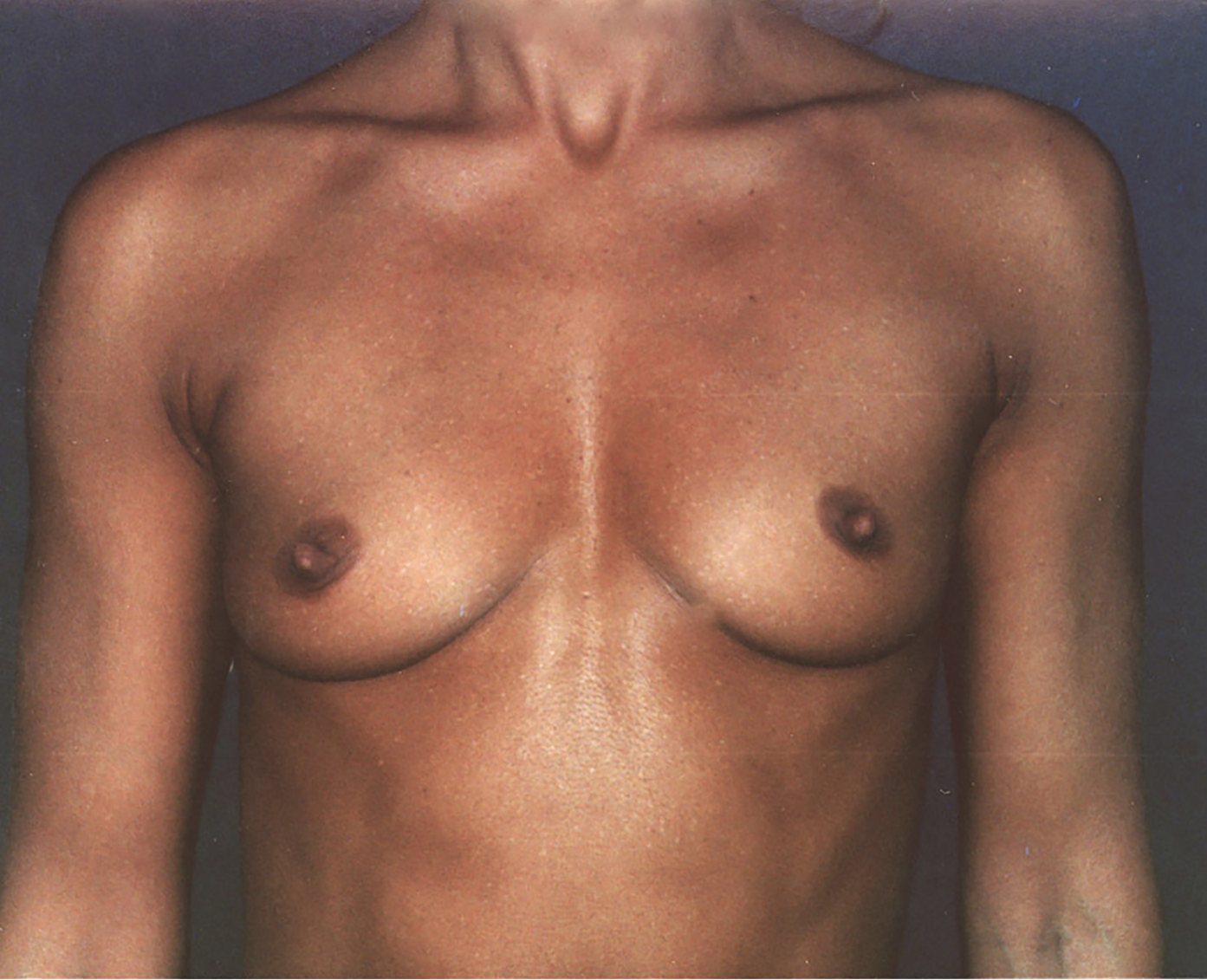 Before – Case 10 · Age 30 · Silicone implants · Submuscular placement · High profile