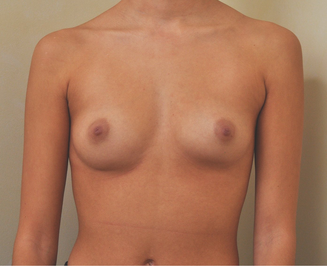 Before – Case 13 · Age 23 · Silicone implants · Submuscular placement · High profile
