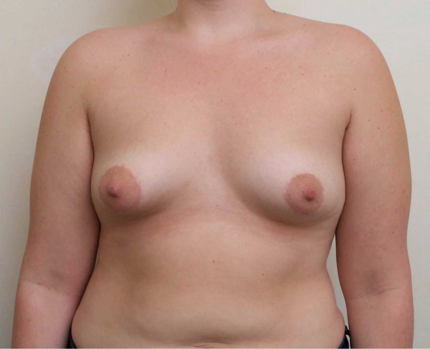 Before – Case 16 · Age 26 · Silicone implants · Submuscular placement · High profile