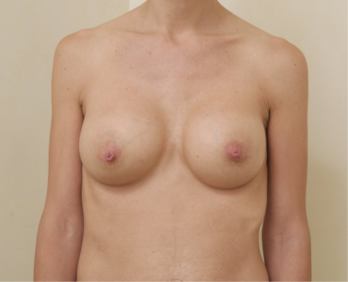 After – Case 17 · Age 39 · Silicone implants · Submuscular placement · High profile