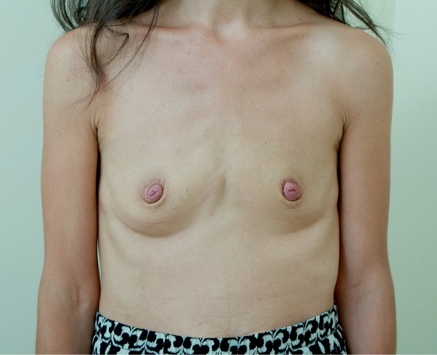 Before – Case 17 · Age 39 · Silicone implants · Submuscular placement · High profile