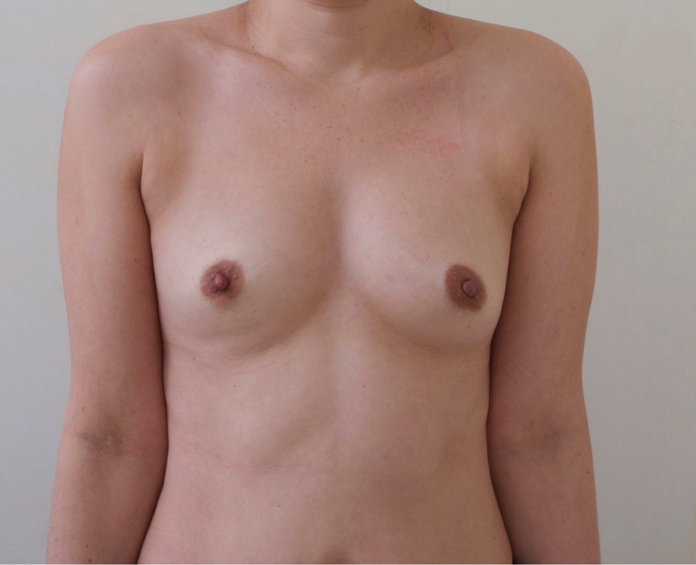 Before – Case 24 · Age 44 · Saline implants · Submuscular placement · High profile