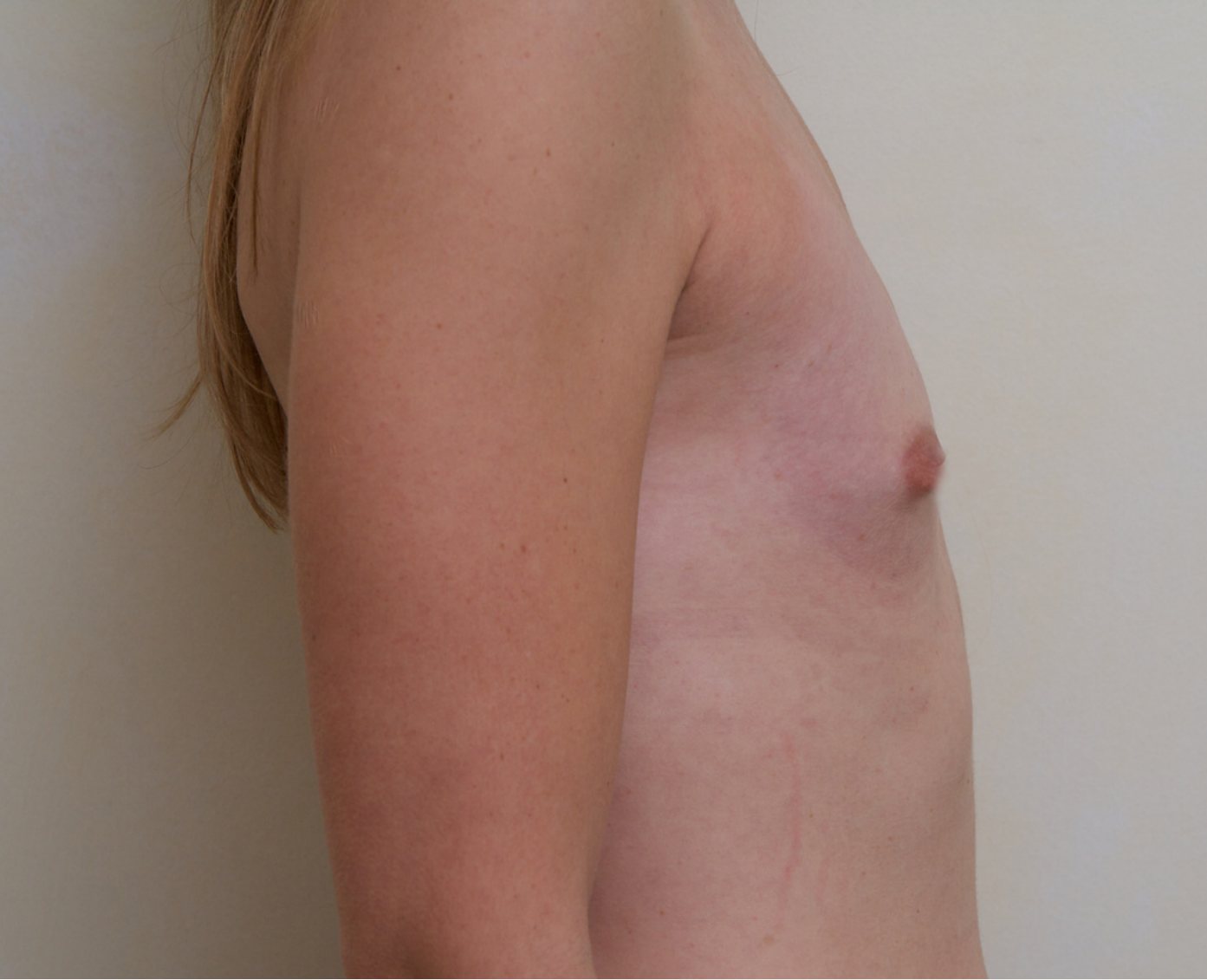 Before – Case 25 · Age 27 · Silicone implants · Submuscular placement · High profile