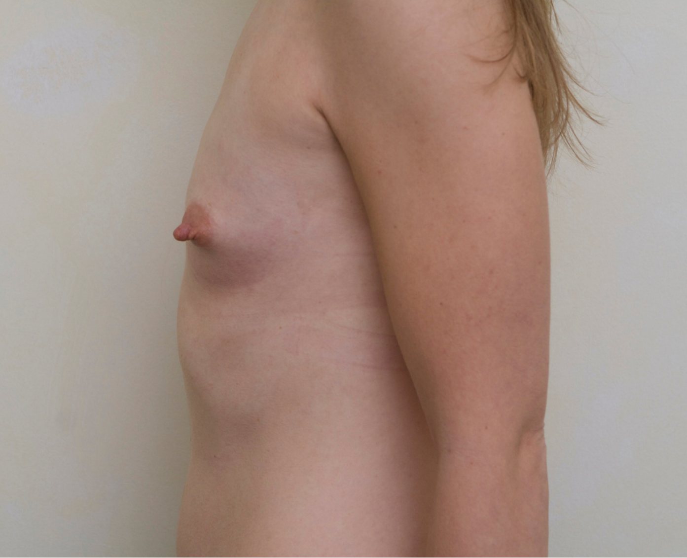 Before – Case 28 · Age 27 · Silicone implants · Submuscular placement · Moderate profile