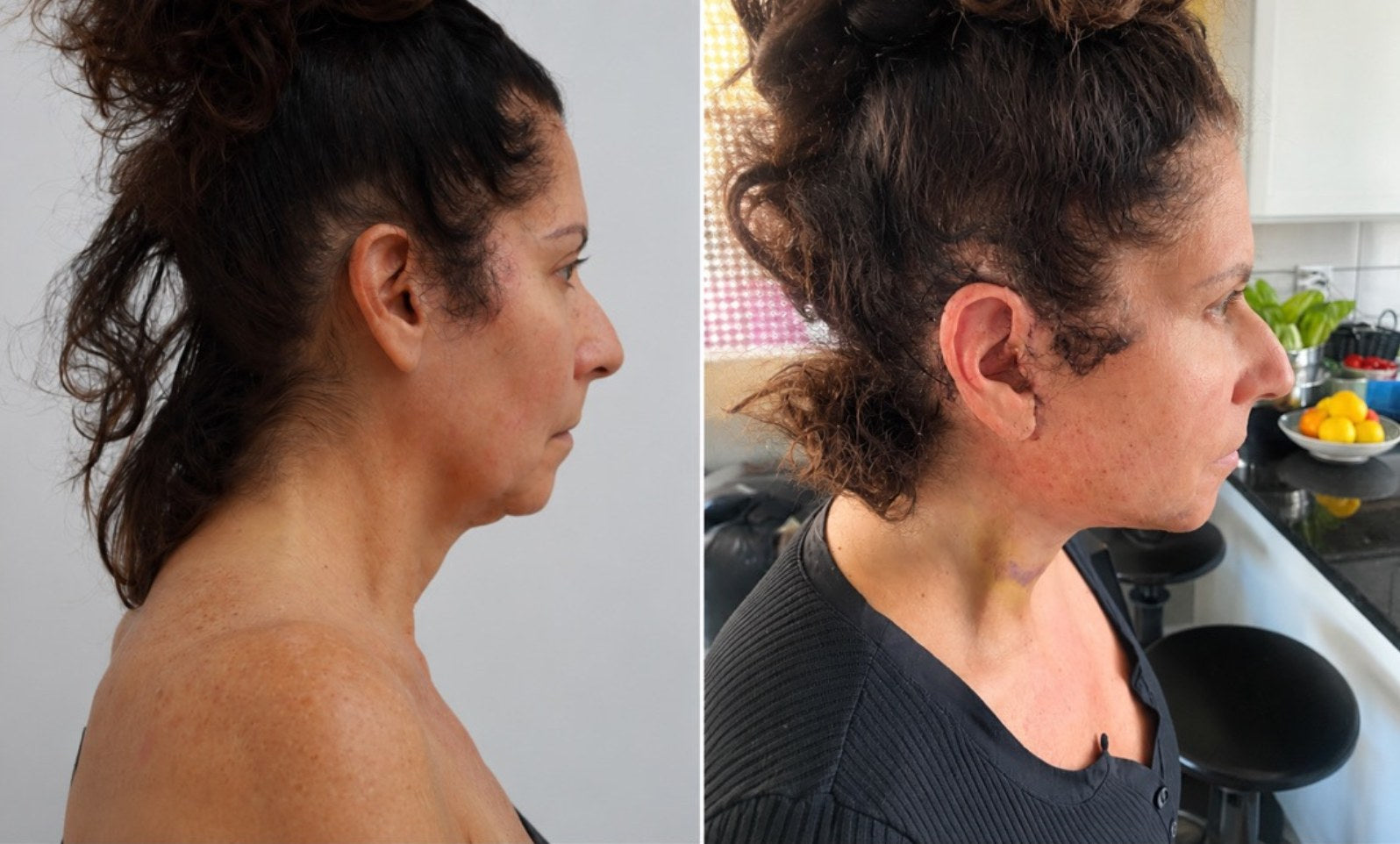 Profile comparison of the featured patient before face and neck lift surgery and one day after surgery.