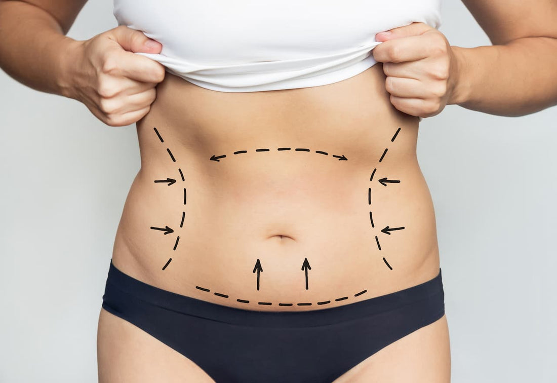 Awake Liposuction in NYC: Is It Right for You?
