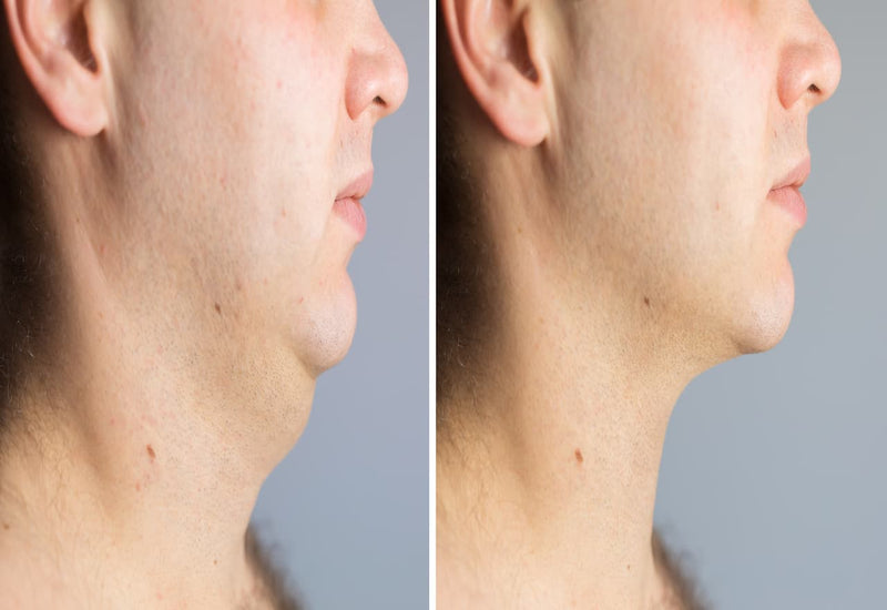 Say Goodbye to Double Chins: Liposuction That Works
