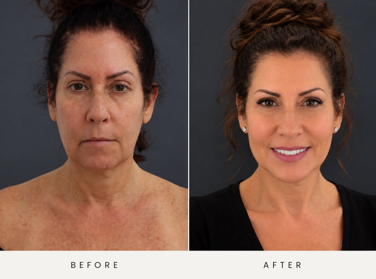 Before and after facelift and neck lift, front view. Patient featured in the story “Wanted to look like me again.”