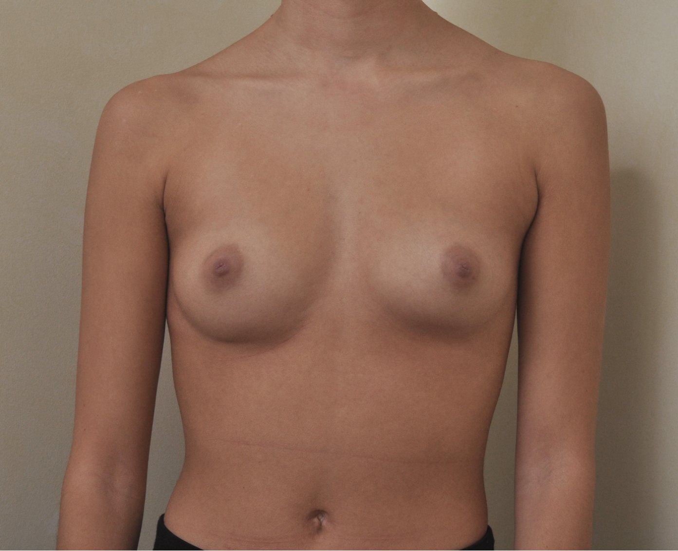 Before – Case 11 · Age 24 · Silicone implants · Submuscular placement · High profile