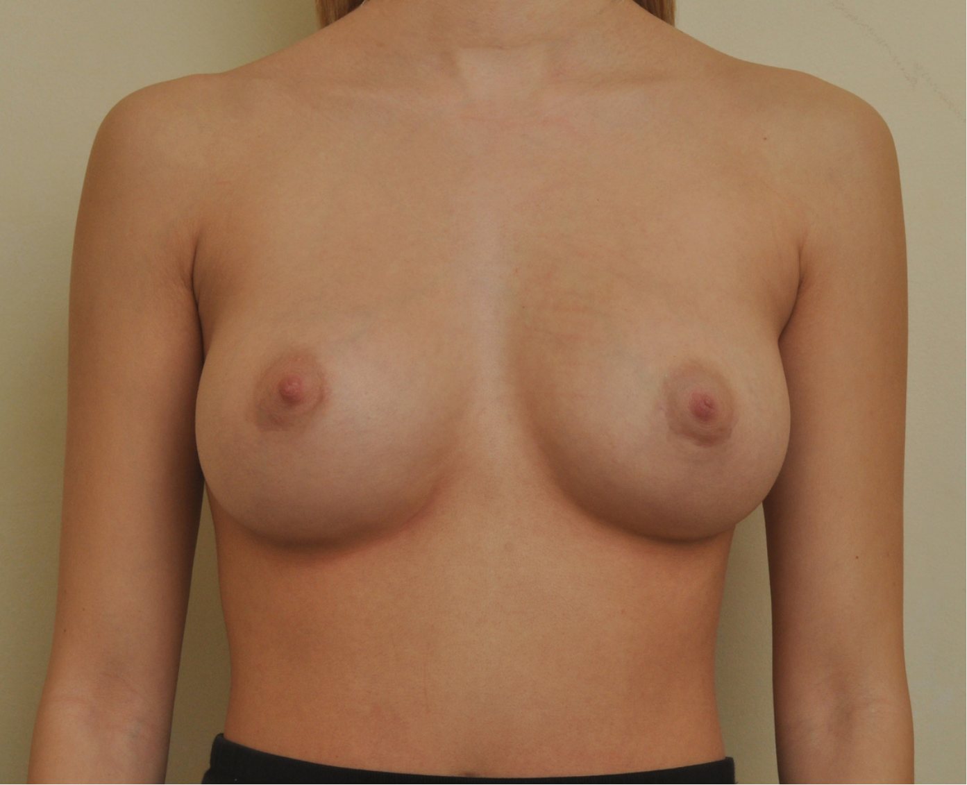 After – Case 13 · Age 23 · Silicone implants · Submuscular placement · High profile