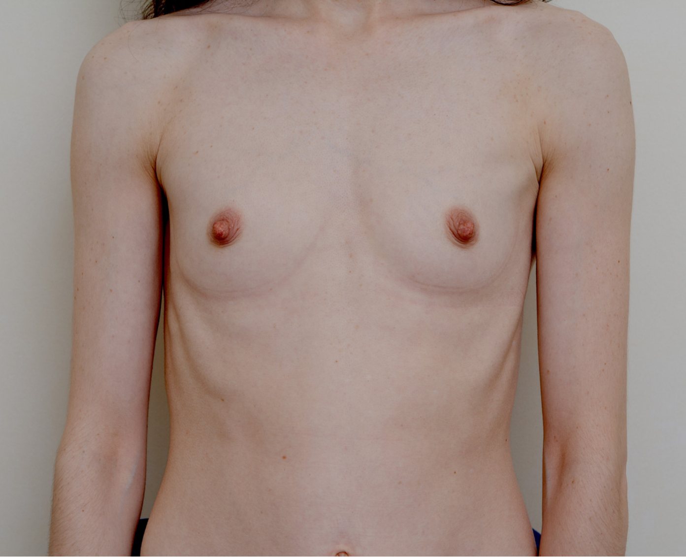Before – Case 21 · Age 40 · Silicone implants · Submuscular placement · Moderate profile