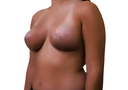 Breast Lift-after