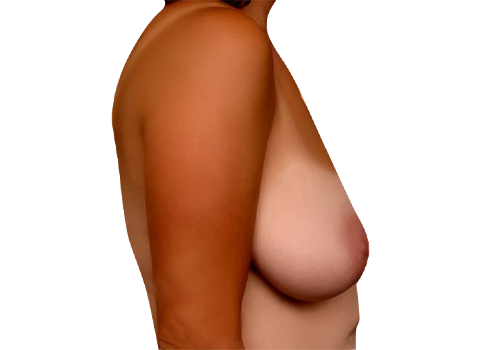 Breast Lift-before-2