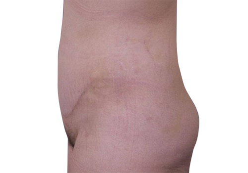 Drain-free tummy tuck after-3