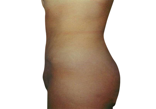 Drain-free tummy tuck after-4