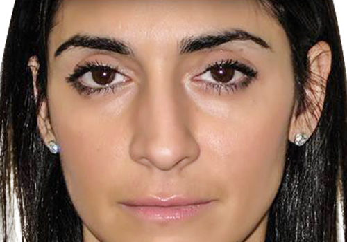 Eyelift Plastic Surgery after-1