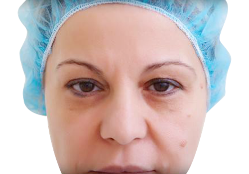Eyelift Plastic Surgery before–2