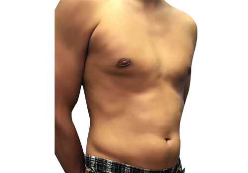 Male Breast Reduction after 1