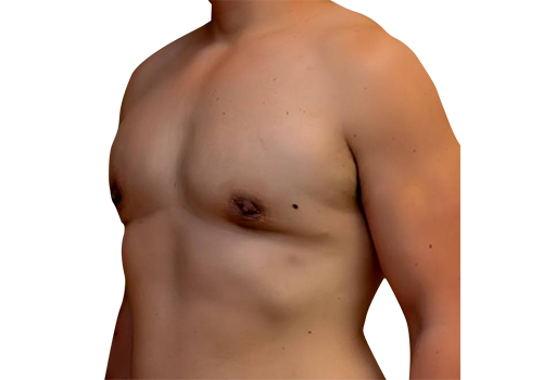 Male Breast Reduction after 2