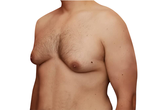 Male Breast Reduction before 2