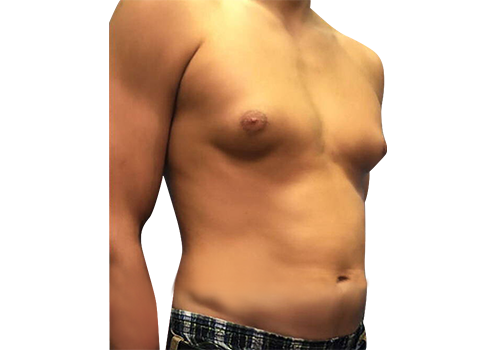 Male Breast Reduction before 1