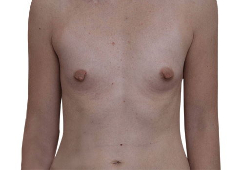 Breast Implants before 10