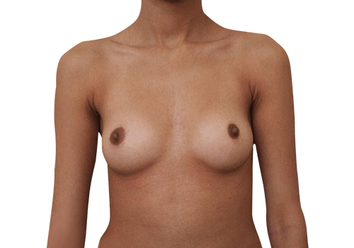 Breast Implants before 3