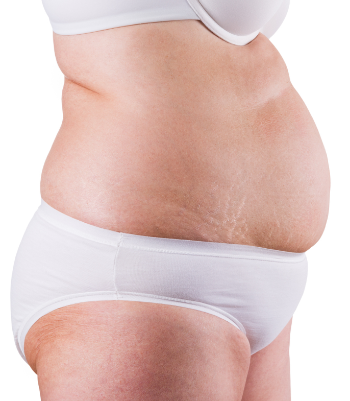 women belly fat