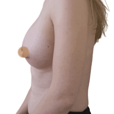 breast implant after 24 small preview