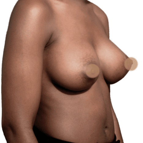 breast implant after 25 small preview