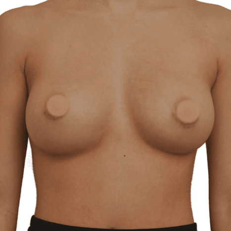 breast implant after 4
