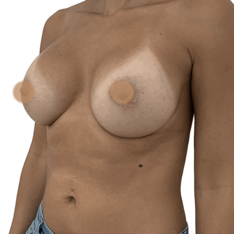 breast implant after 28
