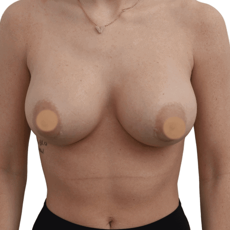breast implant after 6