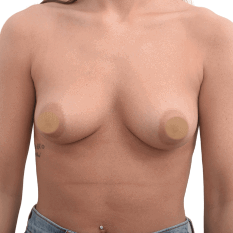 breast implant before 6