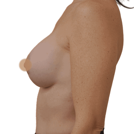 breast implant after 29 small preview