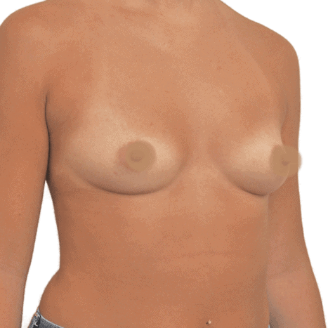 breast implant before 32