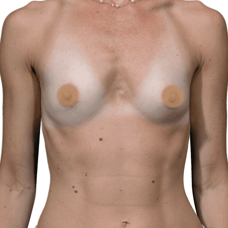 breast implant before 10