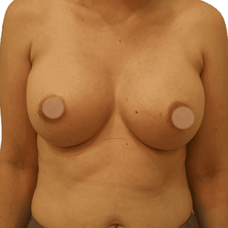 breast implant after 8