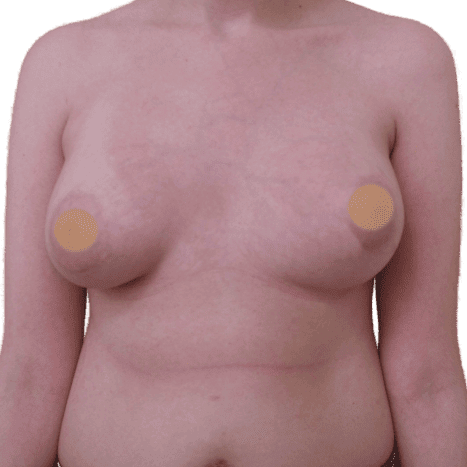 breast implant after 10