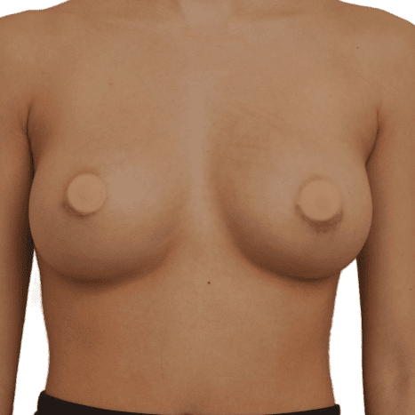 breast implant after 16 small preview