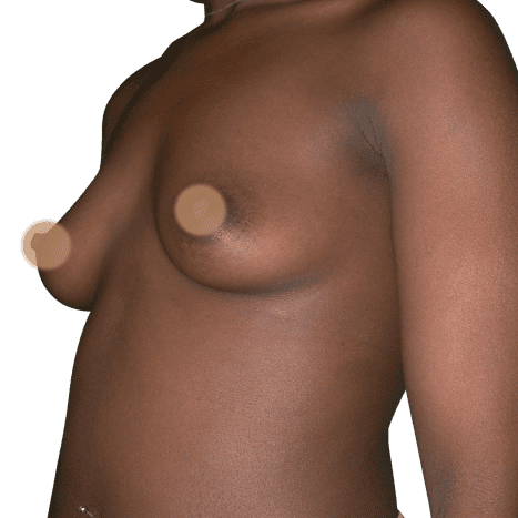breast implant before 34