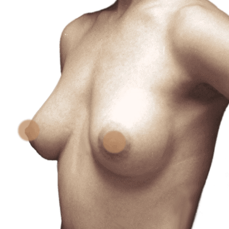 breast implant after 23 small preview