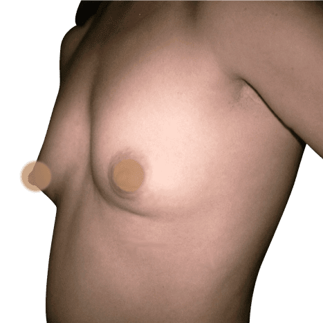 breast implant before 23 small preview